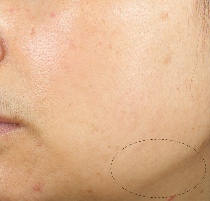 Ten înainte de folosirea cremei Vital Perfection Advanced