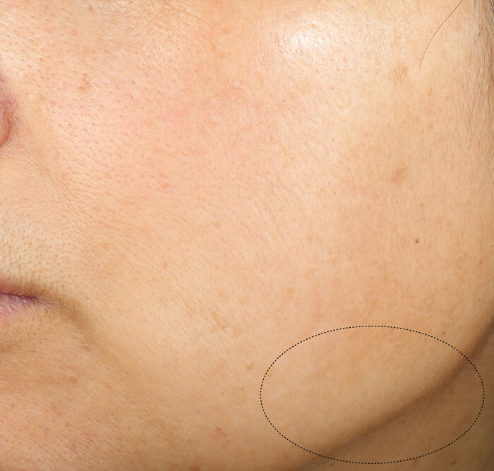 Ten după folosirea cremei Vital Perfection Advanced